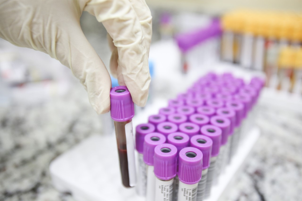 Para identificar se o paciente sem sintomas teve ou não contato com o Sars-CoV-2, o coronavírus, o médico pode indicar a realização do exame de Sorologia IgM e IgG ou IgA e IgG, também conhecido como teste imunológico